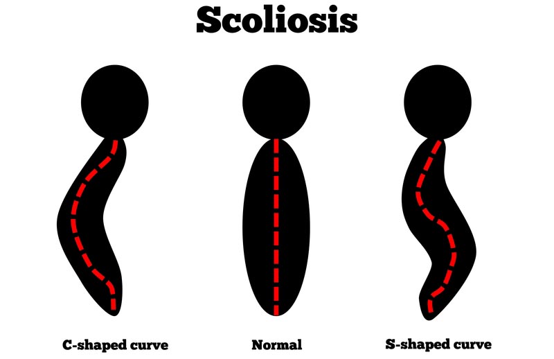 Oklahoma City, OK scoliosis treatment